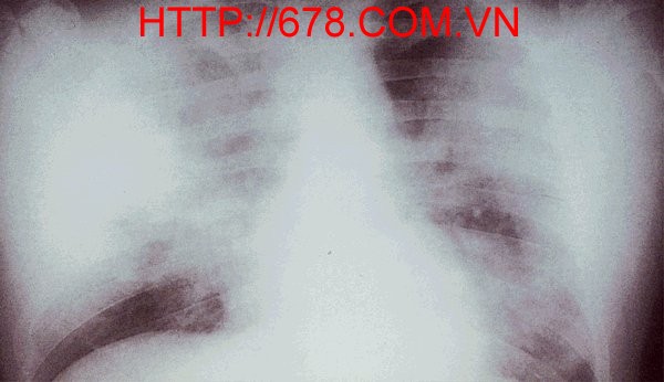 Bệnh phổi Legionnaire